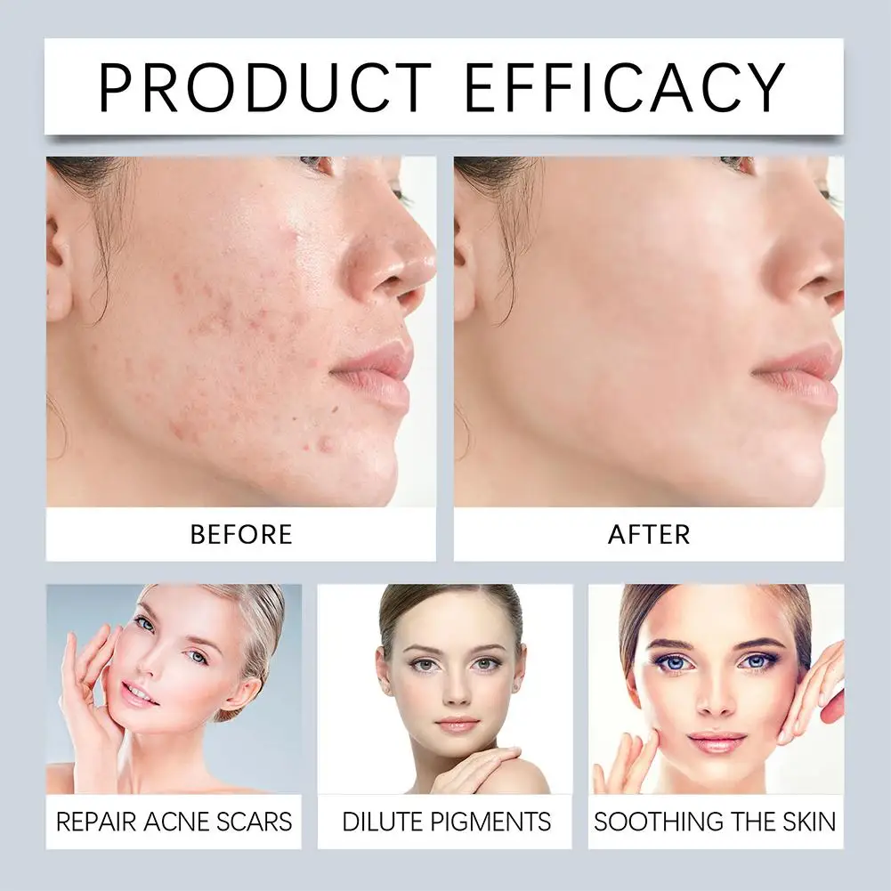 2% 살리실산 세럼은 섬세한 모공을 조여줍니다. 페이셜 에센스 하이드레이팅 젠틀 수축 모공 여드름 제거 세럼 페이스 스킨 케어