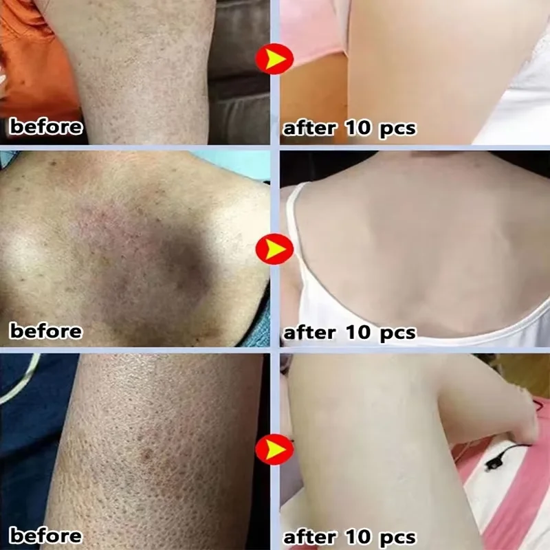 Krim Perbaikan kulit ayam, pengobatan Keratosis folikel Pilaris tubuh bintik hitam menghilangkan pori-pori tebal melembabkan esensi Lotion