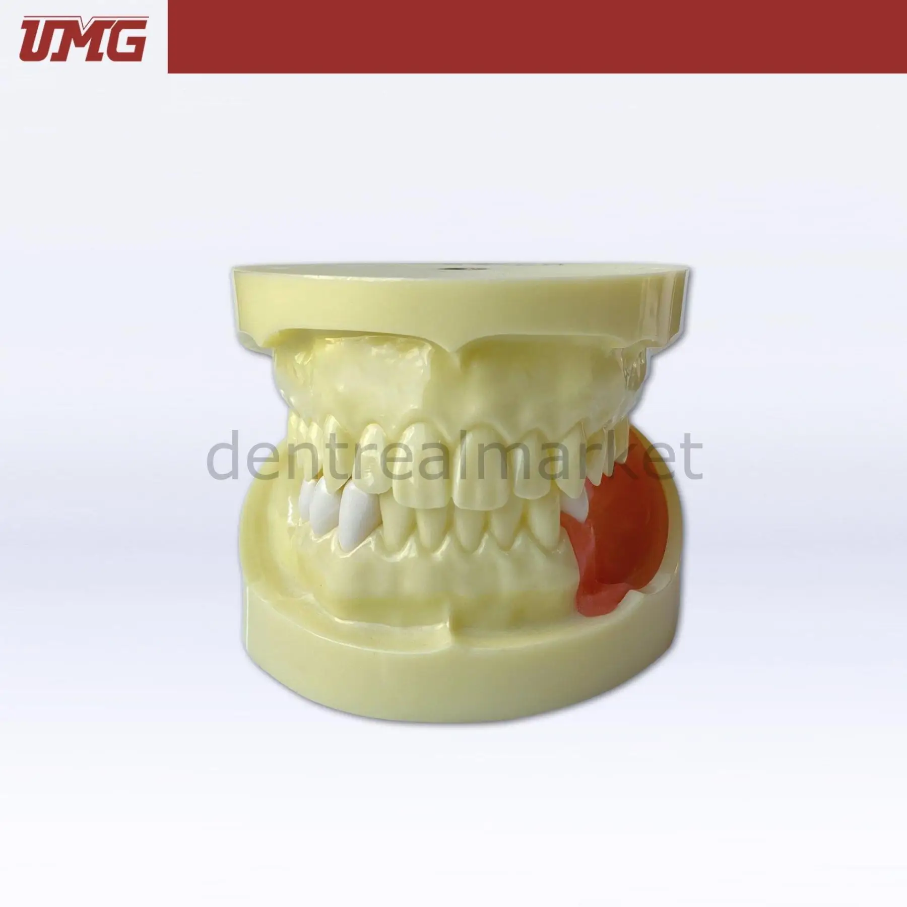 UMG Dental - Umg Model Implant Training Model Upper-Lower Jaw - UM-Z4