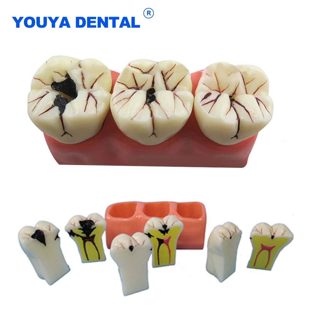 4Times Caries Comparation Models Caries Decomposition Dissected teeth model Teaching research Study model for dentistry students