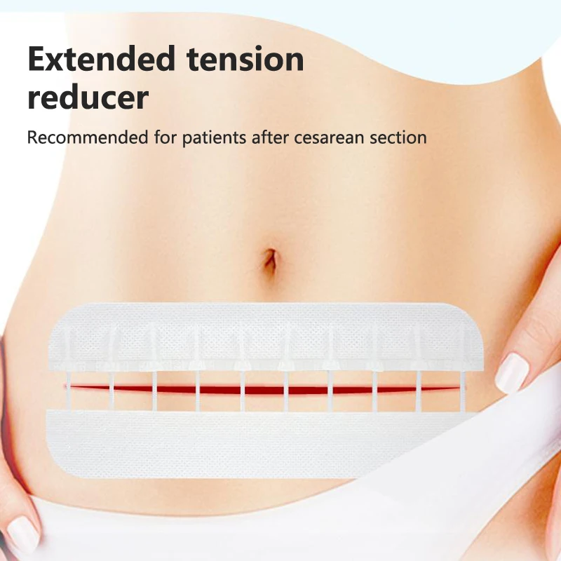 سستة الفرقة المعونة غير مؤلم إغلاق الجرح جهاز خياطة خالية تضميد الجروح بقع البريدي خياطة المخفض الفرقة المعونة في الهواء الطلق المحمولة