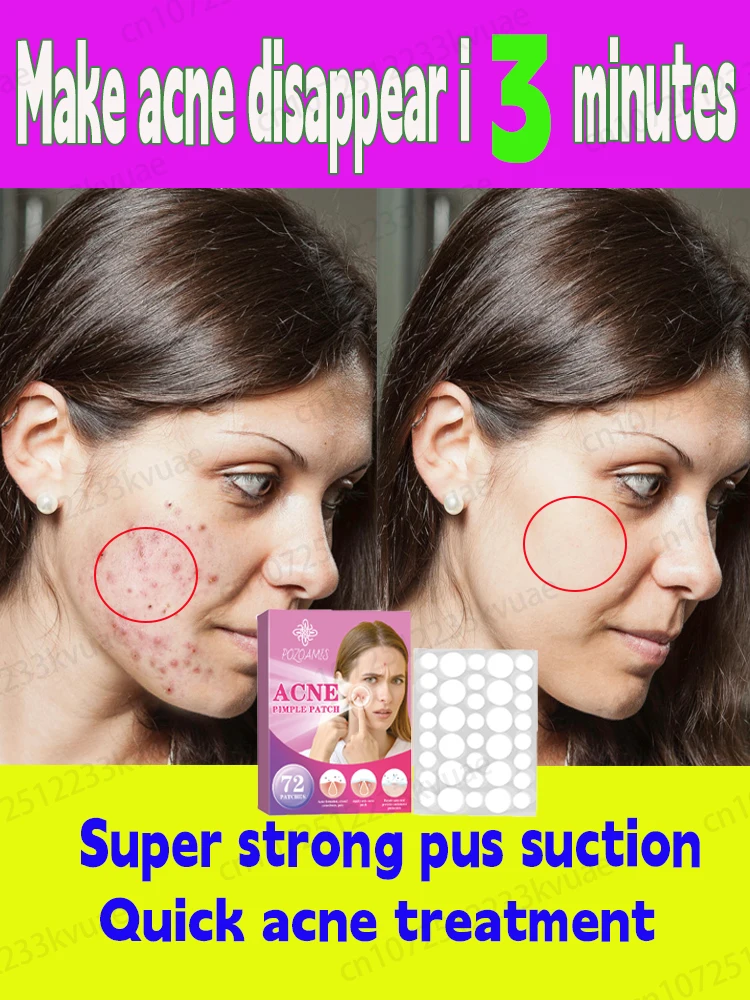 

Say goodbye to your acne-prone skin