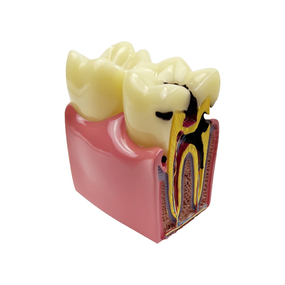 Model zębów Model porównania próchnicy stomatologicznej dla praktyki technika dentystycznego studiowania narzędzi stomatologicznych