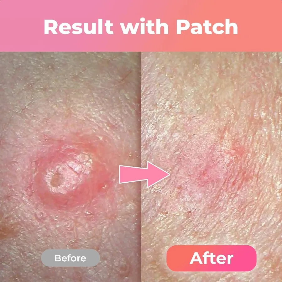 التصحيح المذهل الكورية Skintech بثرة التصحيح غير مرئية بقعة غطاء حب الشباب بقع للوجه Zit والعيب بقع 90ea