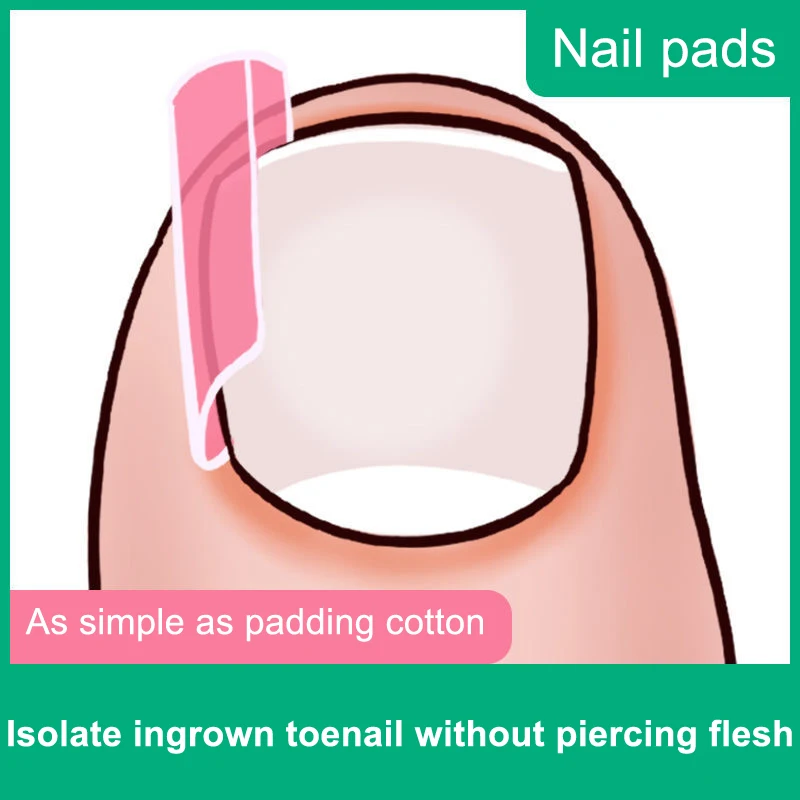 10/20/30/40/50/60Pcs Ingrown Toenail Corrector Elastic Patch Sticker Straightening Clip Brace With Nail Remover Pedicure Tools