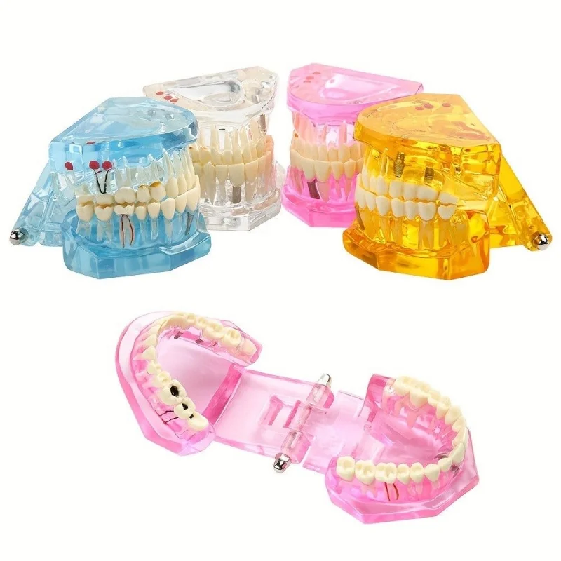 Dental Teeth Model Implant Disease  Dentist Study Model With Restoration Bridge Tooth Demonstration Models For Patient Education