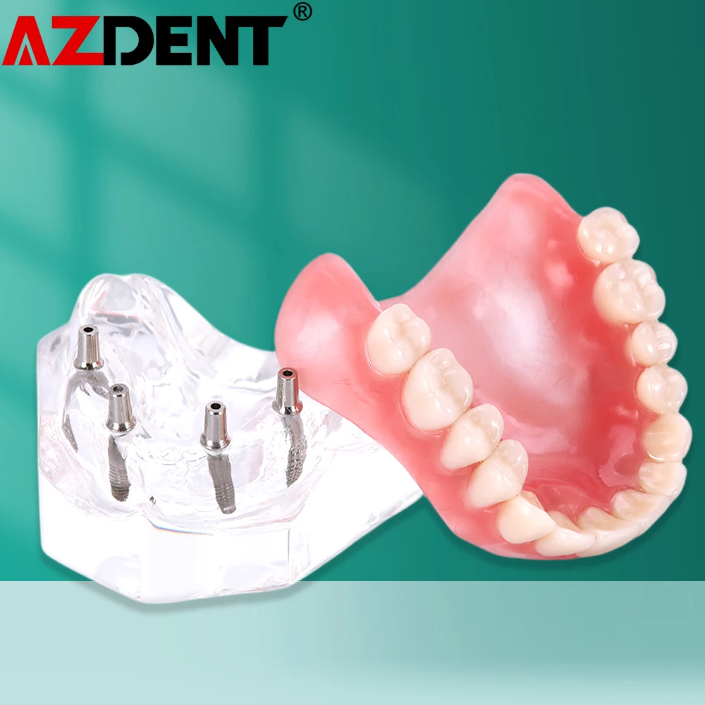 Dental Overdenture zęby Model nauczania zdejmowane wnętrze żuchwa z implantem tylko do celów demonstracyjnych