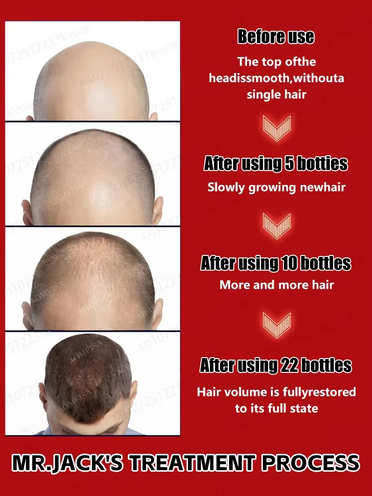 Sem desconforto, ss, taxa de redução de gordura 100% Sem desconforto, 