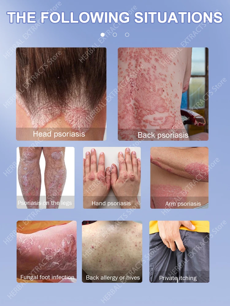 psoriasis ointment cream