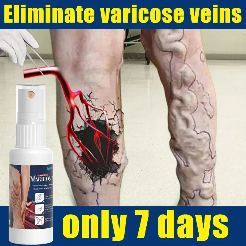 

Varicose Vein Spray Herbal Angiitis Remedy Spray Relief Veins Hurt Phlebitis Legs Varicose Vein Spray For Legs Care