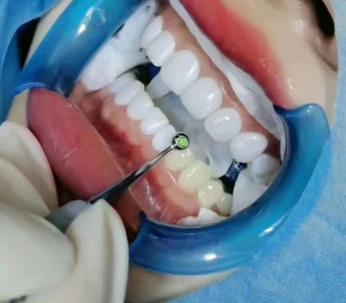 Imagen 2 del producto Espátula de relleno de resina Dental, almohadilla de moldeo Dental, herramienta de resina compuesta Anterior y Posterior, herramienta de modelado de espuma para blanquear los dientes