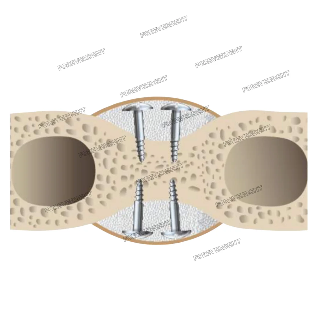 

Dental Driver Tent Nails Half Thread Screw Titanium Guid Regeneration Membrane Tenting Holder Bone Fixation Screws Screwdriver