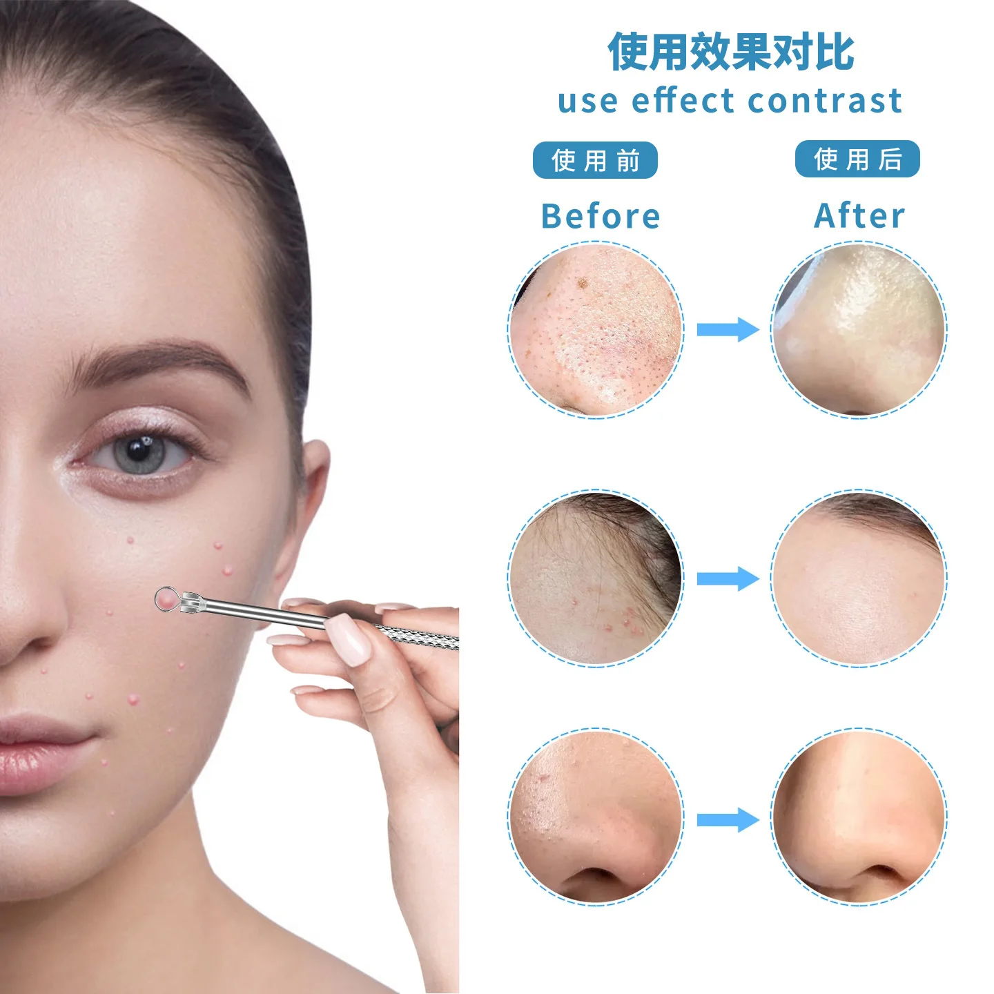 13pcs Blackheads Remover Pore Cleansing Tools Ultra Fine Stainless Steel Acne Needle Tweezers 10x Magnifying Mirror Nasal Strips