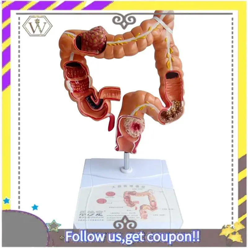 New Teaching Model,Human Large Intestine Anatomy Model Visceral Lesion Model Human Digestive System Learning Model Easy Install
