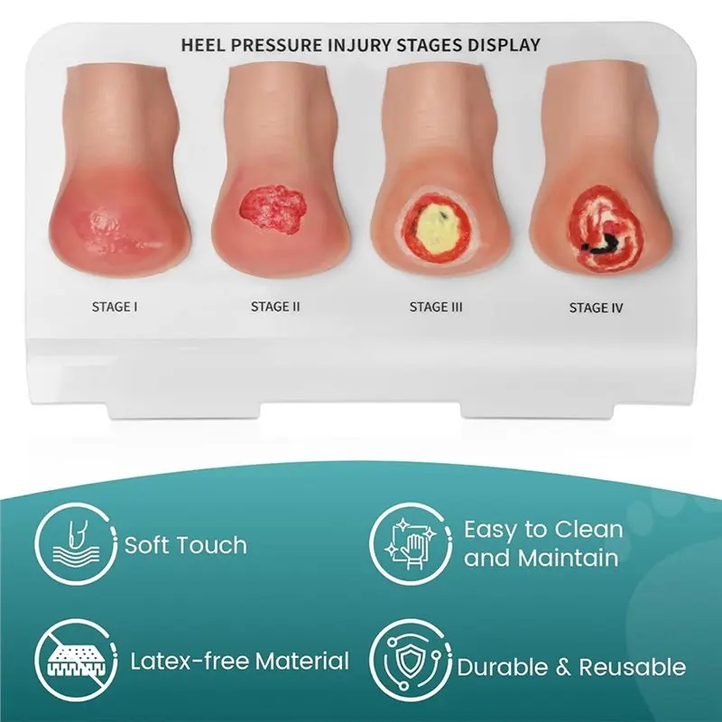 Superior Bed Sore Stages Heel Pressure Injury Stages Model,Heel Ulcer Demonstration Model Education Tool For Training