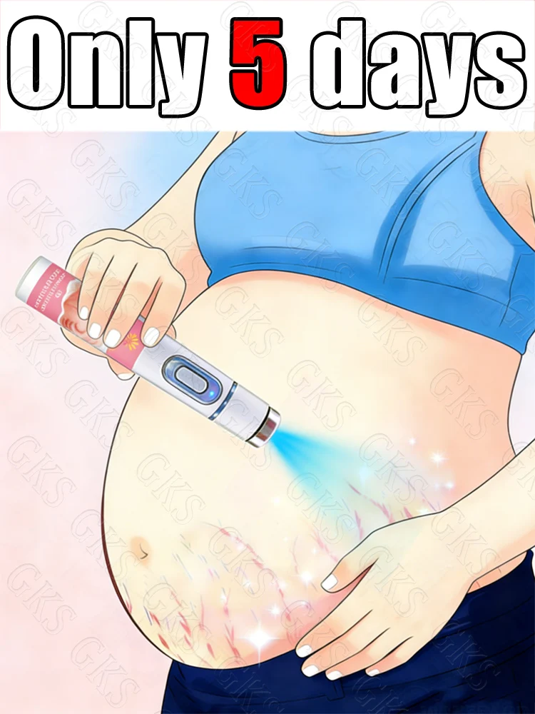 

Home-use laser stretch mark removal device - painless and safety certified