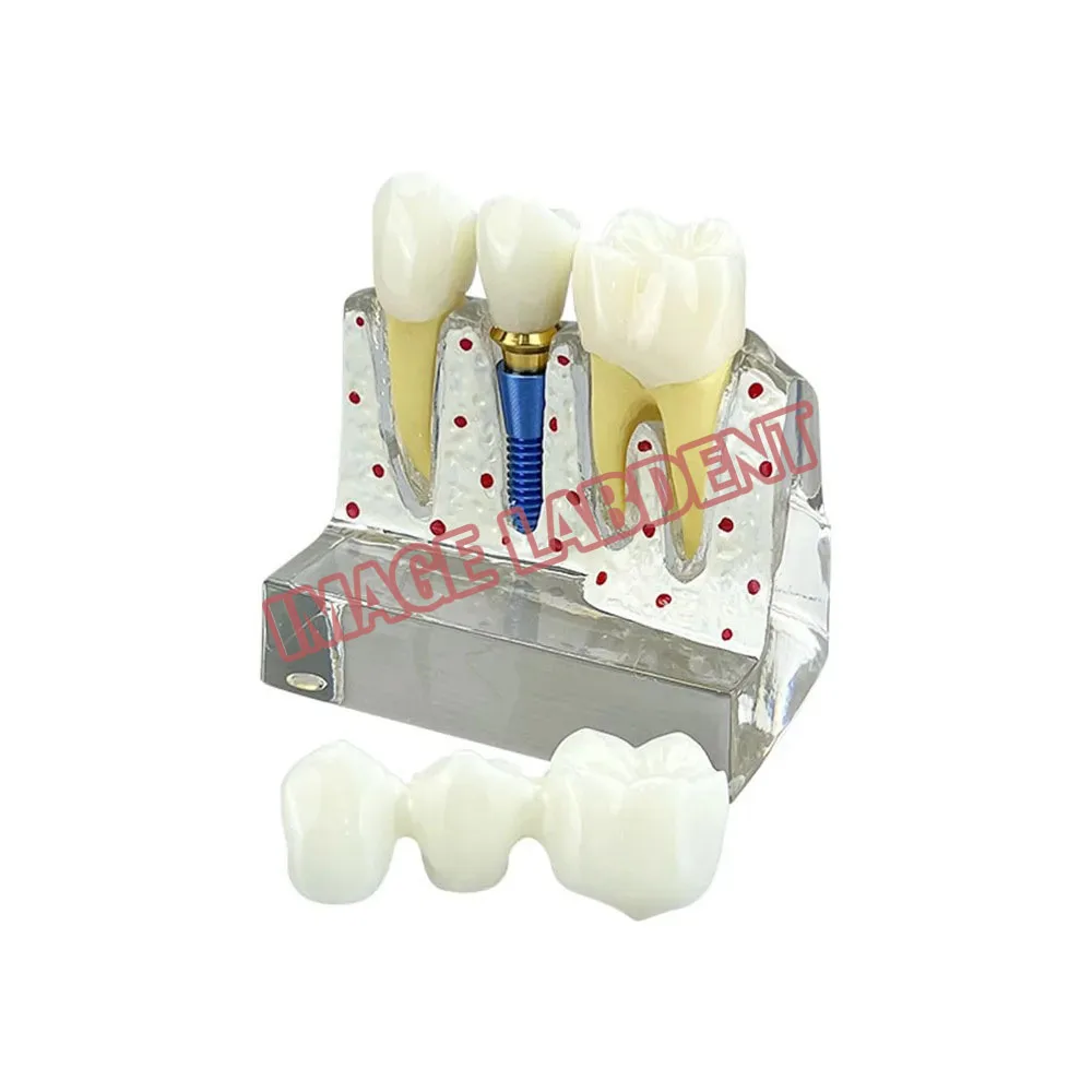 Modelo de demostración de implante Dental 4 veces, análisis de implante Dental, puente de corona, modelo extraíble para dentista, estudiante, enseñar estudio