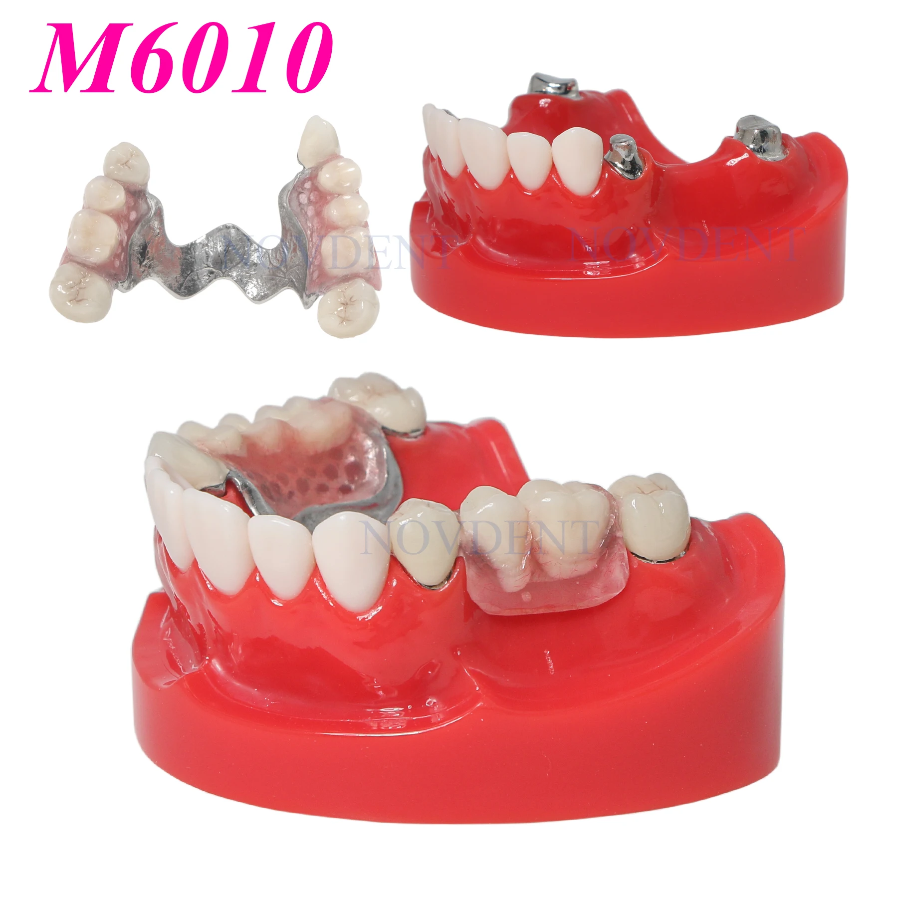 Dental Teeth Implant Model Typodont Restoration Telescope Crown Orthodontic Restoration Model M6010