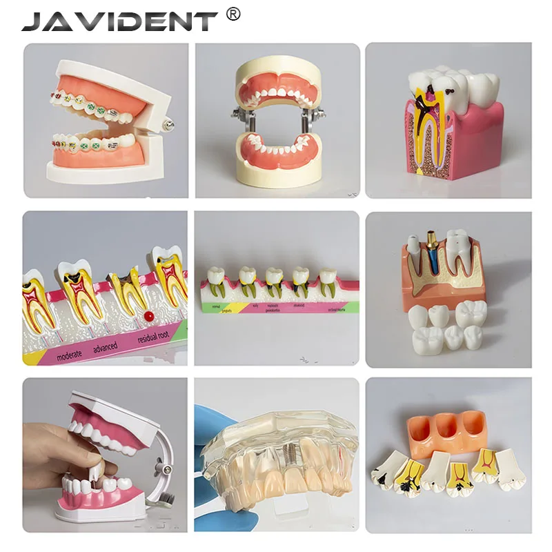 1Pcs Oral Dental Models Implant-Supported Removable Dental Models Full-Mouth Pathology Prosthodontic Patient Communication