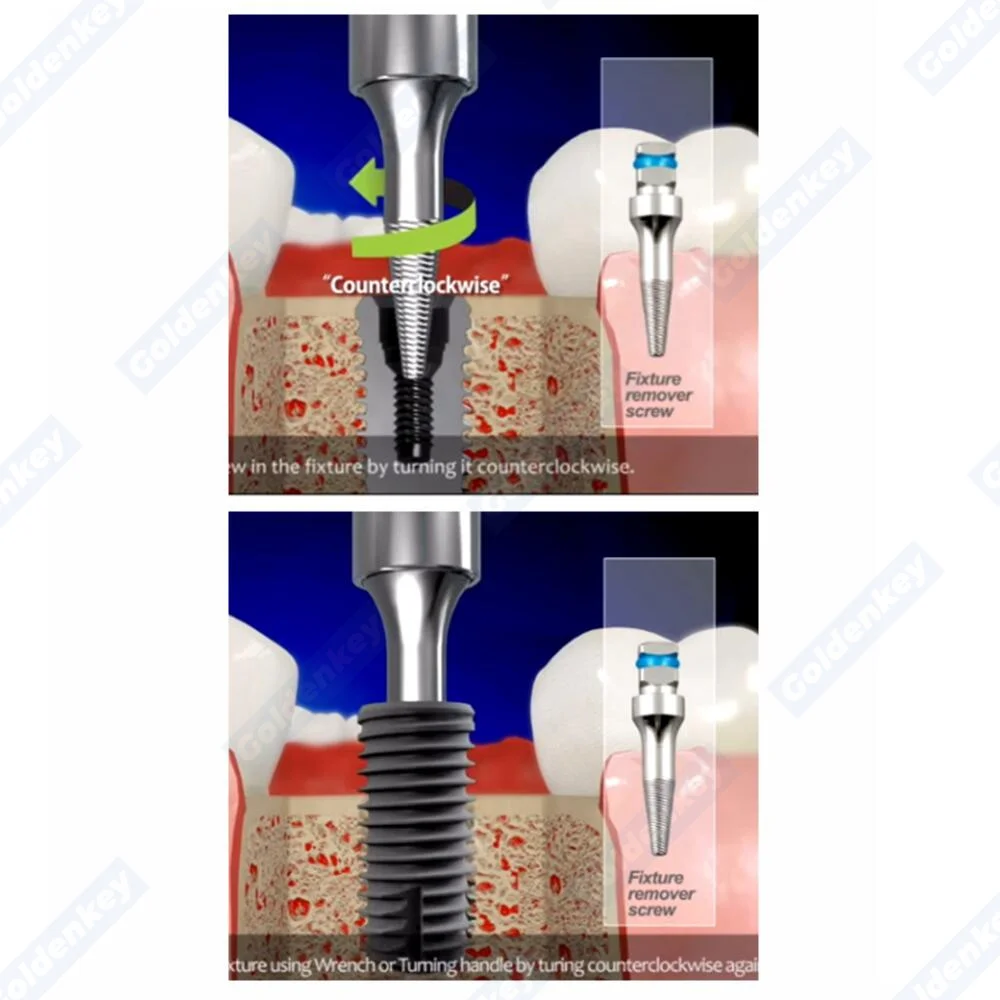 Broken Fixture Remove Failed Screw Wrench Kit Pick Up Extractor Remover Safe Dental Marginal Bone Loss