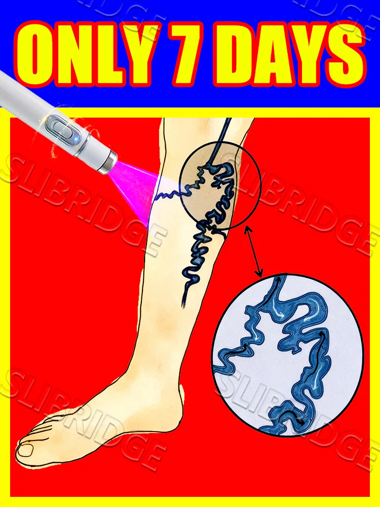 

blue light pen solve veins,veins care tools,free shipping,Regain the confidence of effortless steps