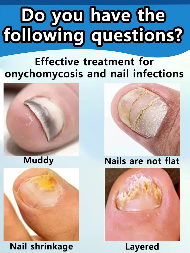 Spray antimicótico para uñas: limpia las uñas dañadas y descoloridas, fácil de usar.