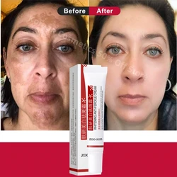 Powerful Spot-removing Whitening Cream Brightening Skin Fast Eliminates Melanin Pigmentation Melasma Dark Spots Korean Skin Care