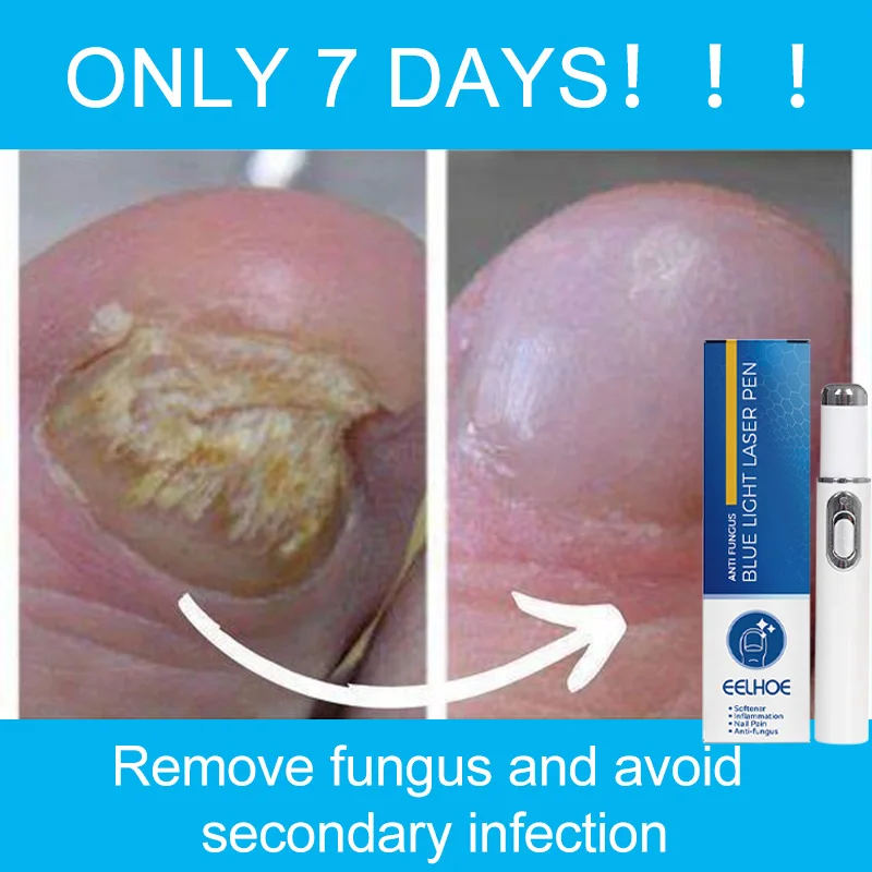 Nail Fungal Treatment Feet Care Essence Repair Nail Fungus Removal Serum Gel Anti Infection Paronychia Onychomy Cosis