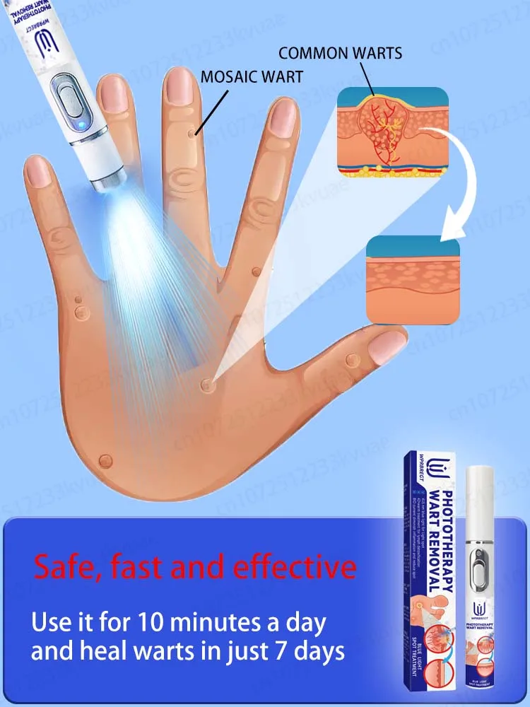 2025 New Upgrade Blue Laser Solve Wart Tool