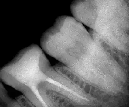 Digitaler oraler Röntgensensor, orales Bildgebungssystem, zahnmedizinischer Röntgensensor R1/R2 mit zahnmedizinischem Krankenhaus, heiße Verkäufe