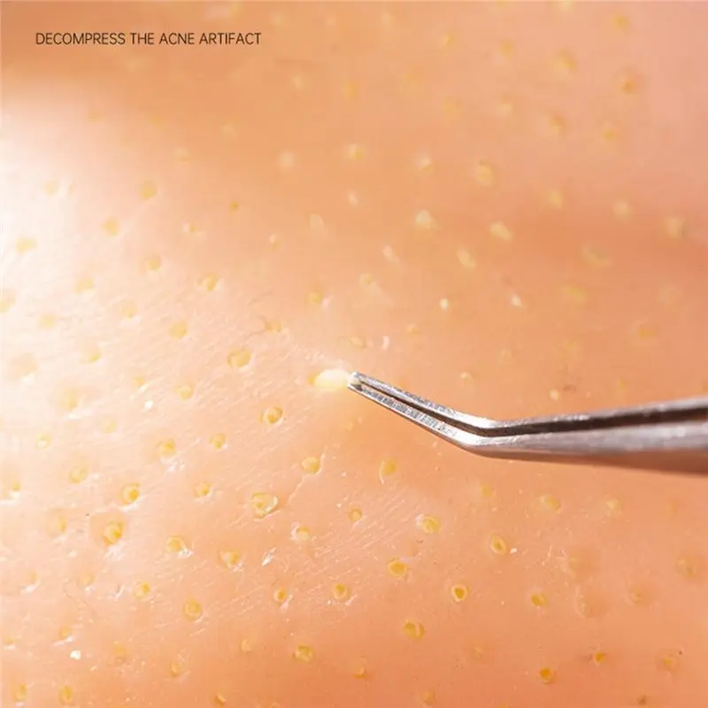 เครื่องบรรเทาความวิตกกังวล ที่กดสิวบนศีรษะด้วยแหนบ ช่วยลดความเครียด กำจัดสิวเสี้ยน สิวอักเสบ บรรเทาความเครียด ของเล่นสัมผัส