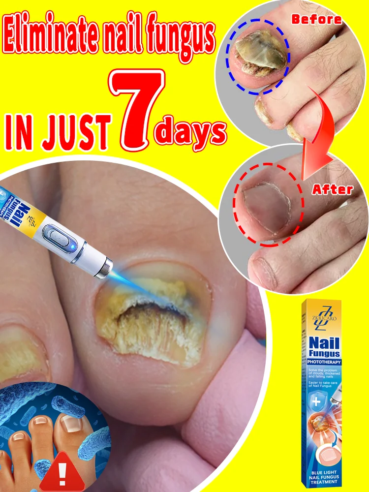 

Fungus nail laser pointer helps to get rid of onychomycosis gray nail Painless and long-lasting sterilization anti-recurrence