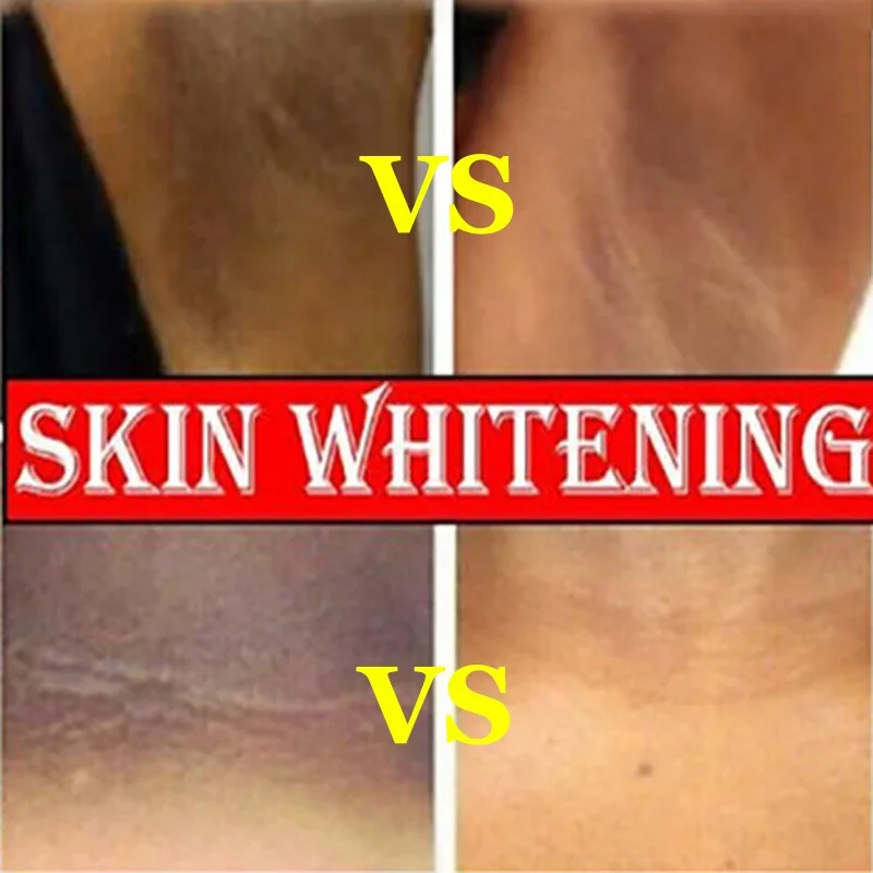 Creme de clareamento partes íntimas axilas branqueamento clarear bunda joelho iluminar parte interna da coxa peças íntimas escuro remover melanina