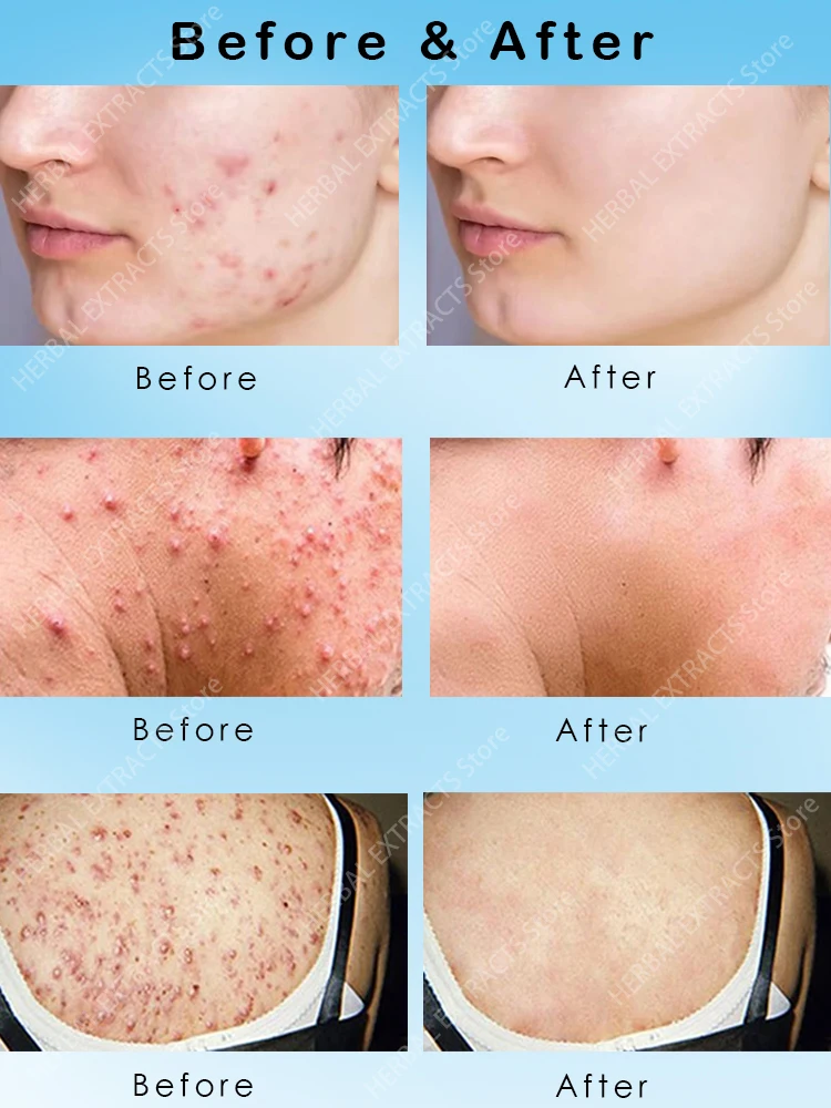 Acne Skin Care