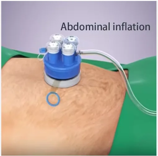 Single Incision Laparoscopic Surgery (SILS) Port Device,single Port Laparoscopy with Wound Protector