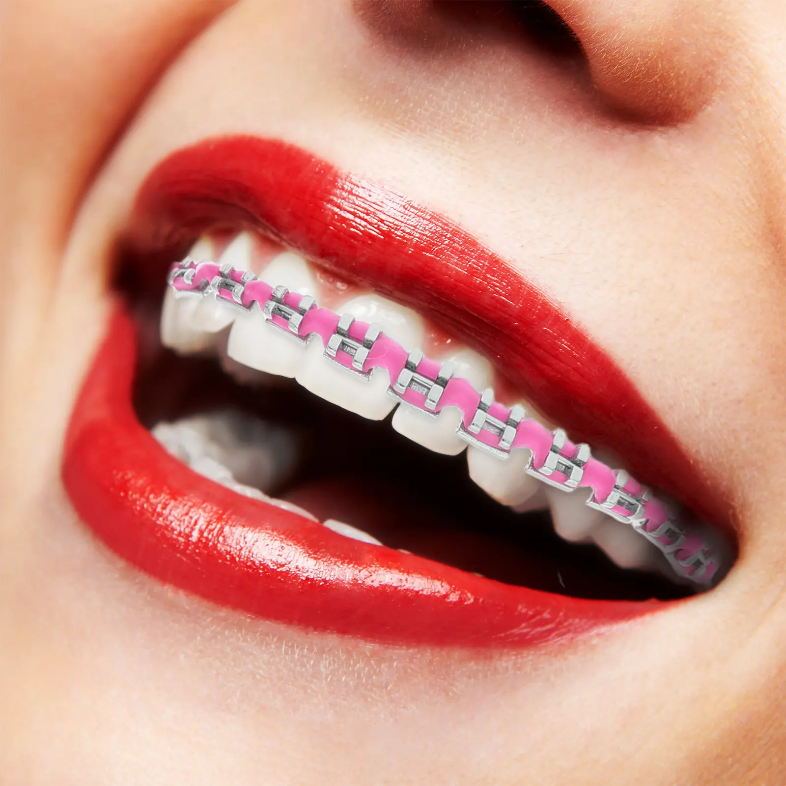 

2pcs Dental Decorations Braces Ornament Easy to Install Remove for Teeth Ligature Ties Orthodontic Ligature Ties Braces Bands