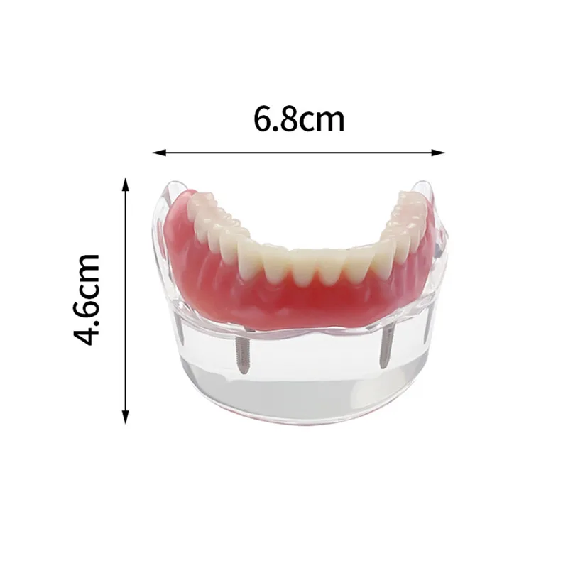 Model zębów protezy dentystycznej z 4 implantami Model demonstracyjny przywracania dolnej części szczęki do komunikacji z pacjentem dentystą