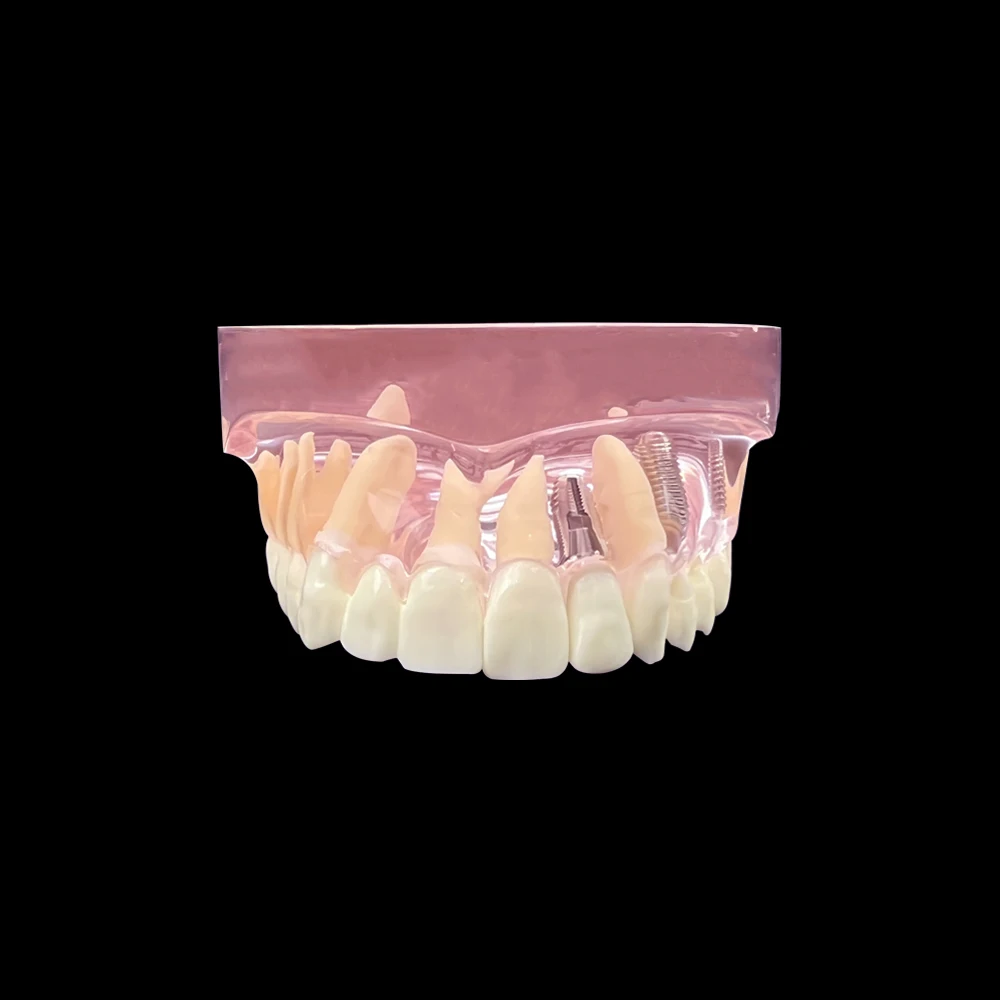 Dental Demonstration Model With 3 Implants Restoration Bridge Typodont Maxillary Teeth Model Removable Tooth Dentistry Models