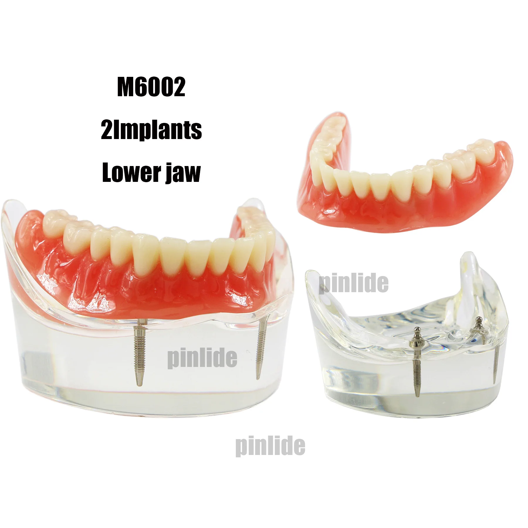 

Dental Implant Model Overdenture Inferior 2 Implants Lower Teeth Demo Study M6002