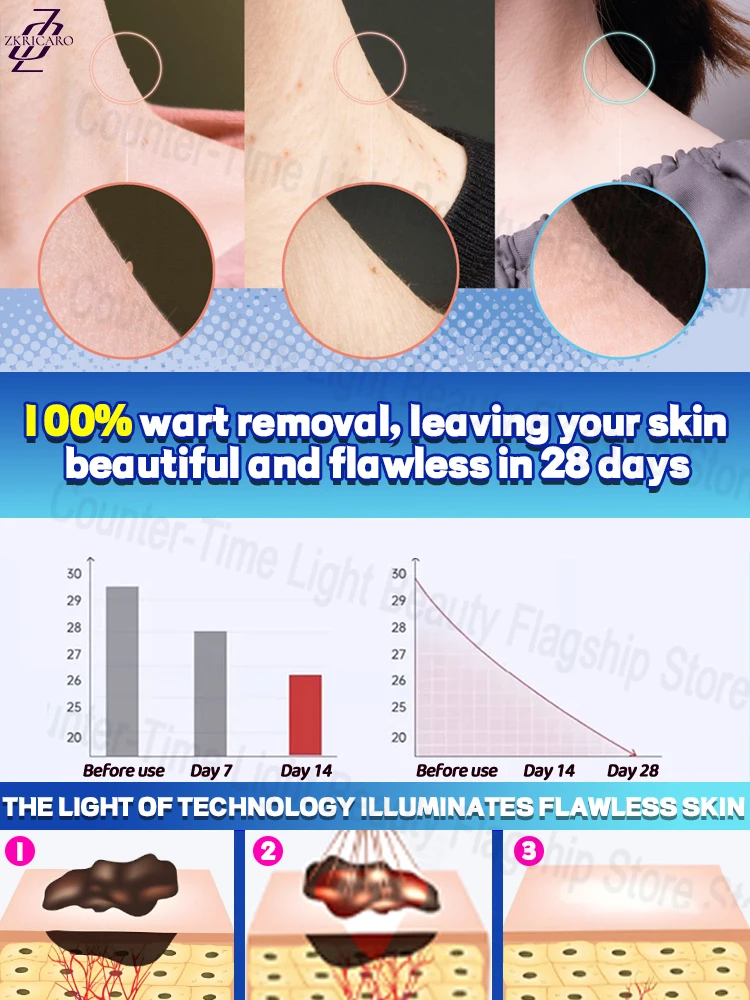 إزالة الثآليل الضوئية، استعادة البشرة الناعمة، إزالة الثآليل الدقيقة، فعالة وخالية من القلق #5