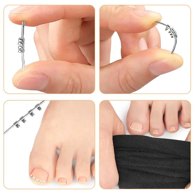 4Pcs Toe Fixation Tape Tool Ingrown Nail Straightening Buckle Toenail Stretch Embed Correction Stretch Tool Get Rid of Ingrown