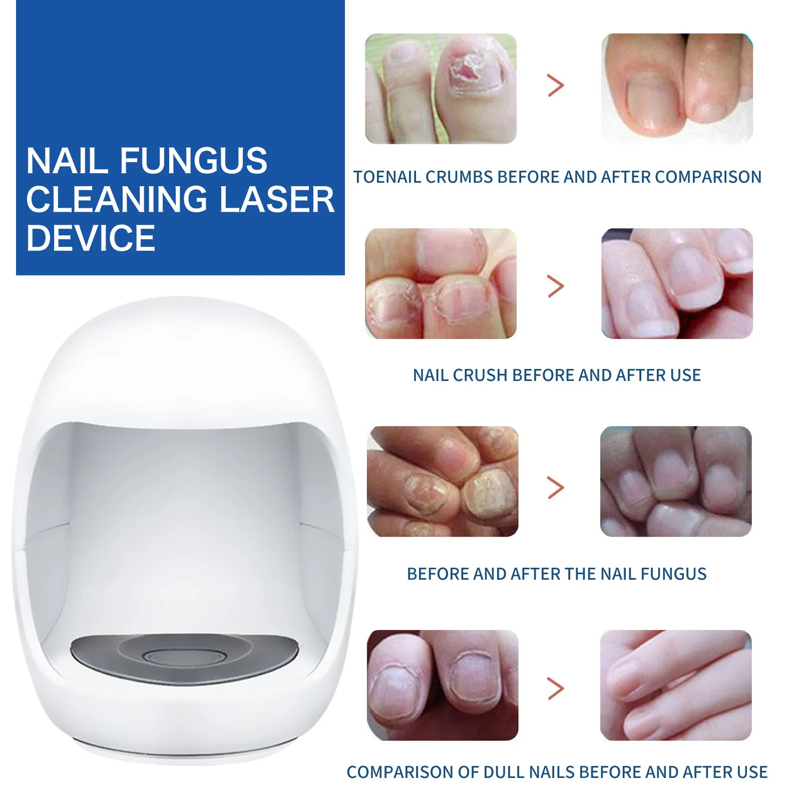 เชื้อราอุปกรณ์เลเซอร์เล็บซ่อมแซมเล็บอย่างรวดเร็วเชื้อรา Onychomycosis