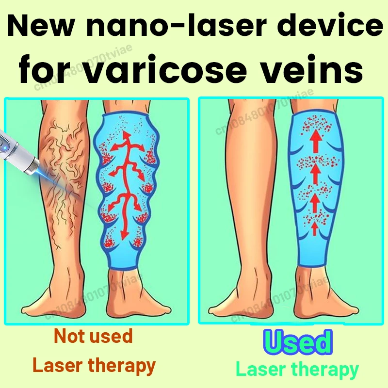 

Solve the problem of varicose veins and say goodbye to the troubles brought by varicose veins to life