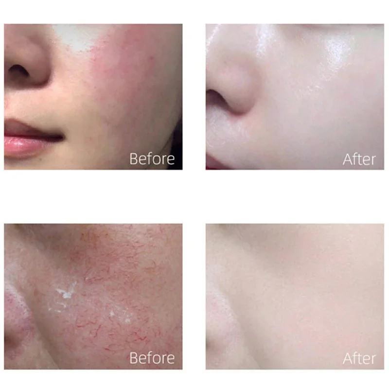 7 Day Repair Redness Serum Sooth Itching Sensitive Skin Improve Rosacea Shrink Pore Smooth Nourish Facial Skin Korean Cosmetics