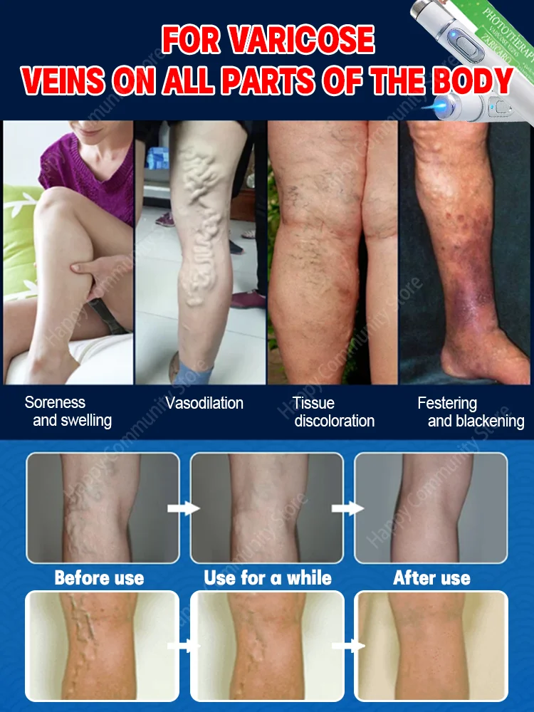 Relieve Pain and Improve Circulation for Both Men and Women,Powerful Laser Therapy for Moderate Varicose Veins