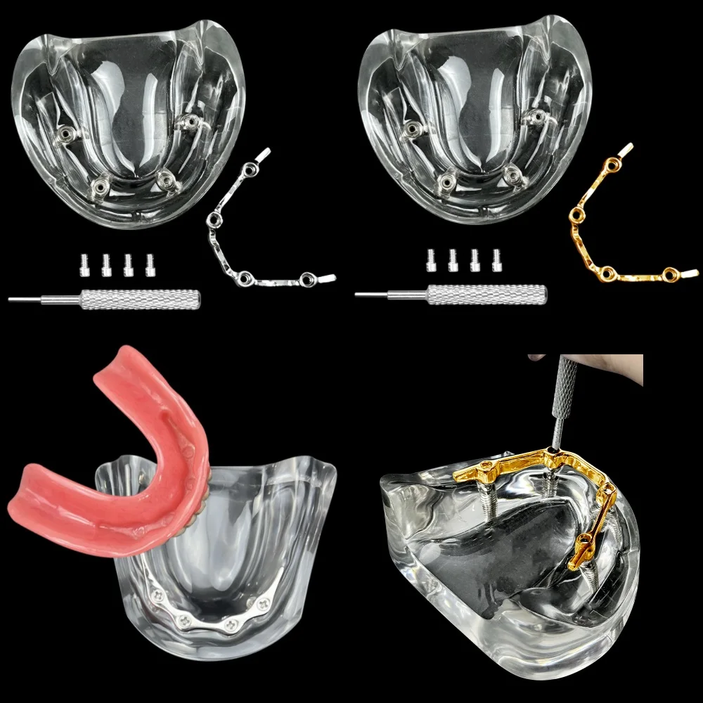 Dental 4 Implants Teeth Model Silver/Gold Rod Type Clear Jaw Overdenture Restoration Model For Dentist Patient Communication