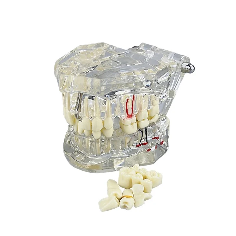 Teeth Model Implant Disease Dentist Studying Model With Restoration Bridge Tooth Demonstration Models
