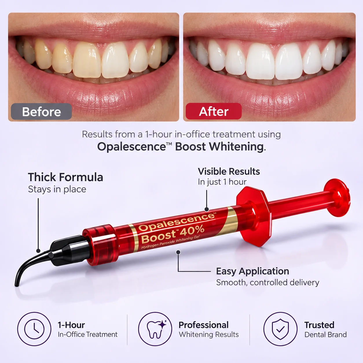 جل تبييض الأسنان أوباليسنس بوس - مراجعة Teeth Whitening Gel Opalescence وسعره