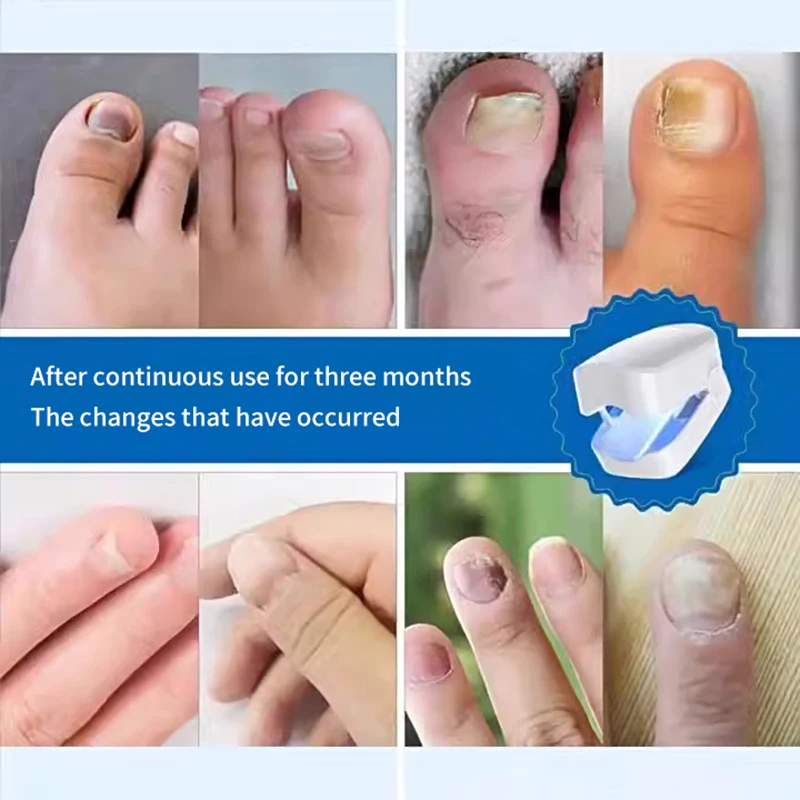 Fungal Toe เล็บอุปกรณ์ซ่อม Fast เล็บเท้าเล็บเชื้อรา Onychomycosis ซ่อมเล็บเท้าเล็บลบเล็บ Fungus Treatment