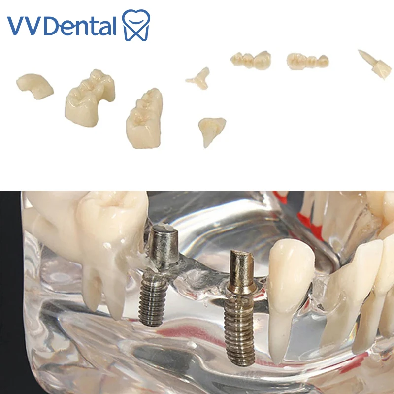 Dental Disease Tooth Model With Removable Tooth Restoration Bridge Teaching Research Tooth Model Dentistry Model